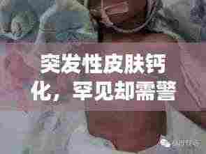 突发性皮肤钙化，罕见却需警惕的皮肤病